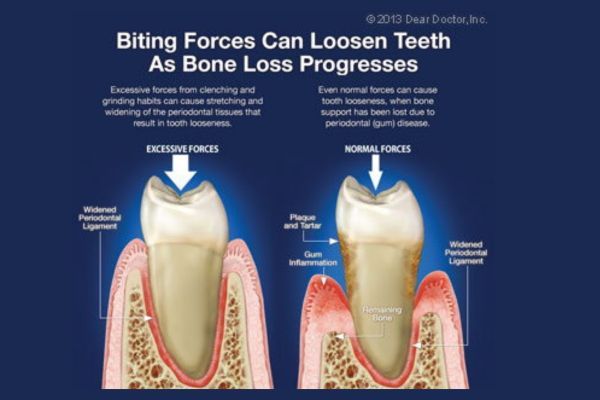 Loose Teeth Bite Problems