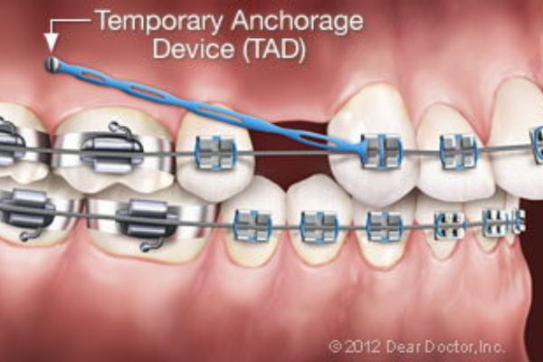 Temporary Anchorage Devide (TAD)