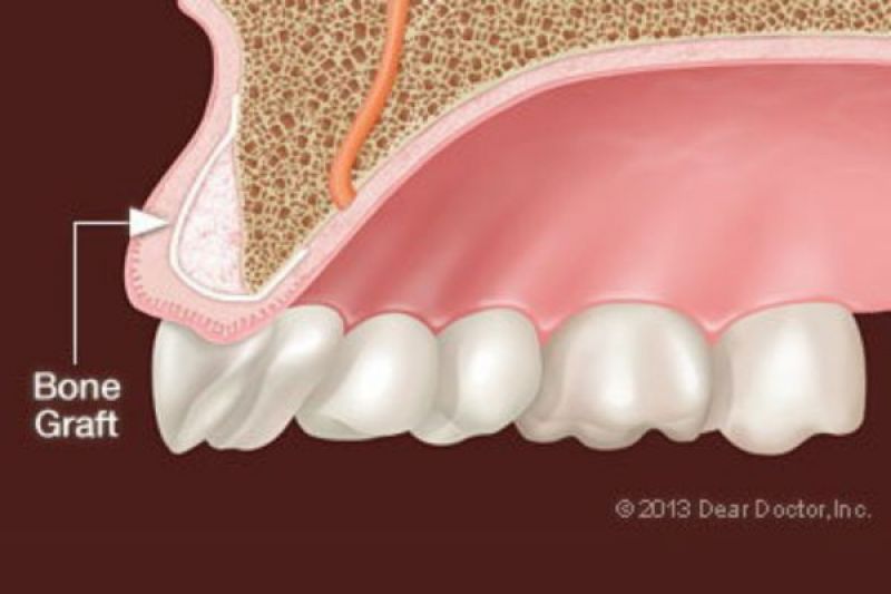 Bone Grafting