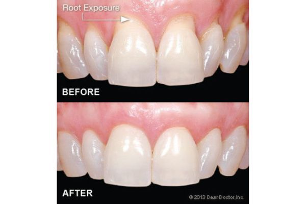 Gum Grafting