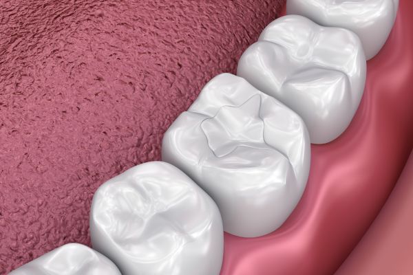 Fillings