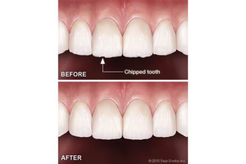Tooth Contouring Reshaping