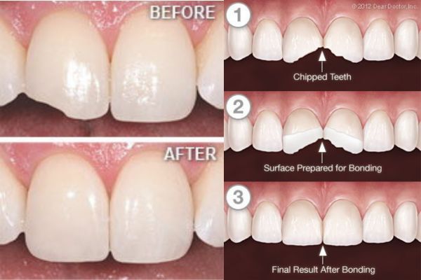 Cosmetic Tooth Bonding