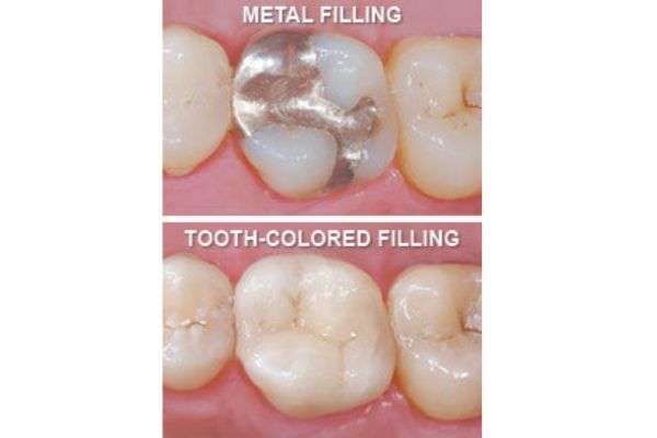Tooth Colored Fillings