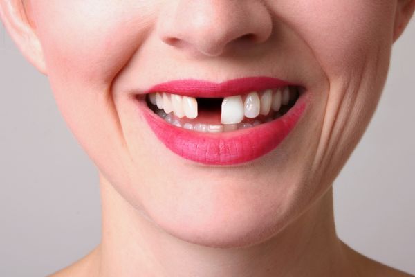 Traumatic Dental Injuries