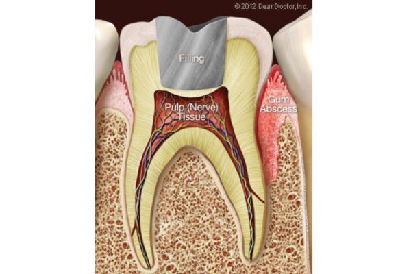 Gum Injuries