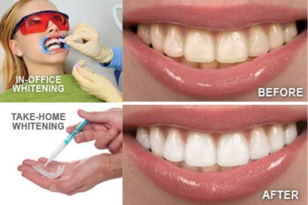 Teeth Whitening