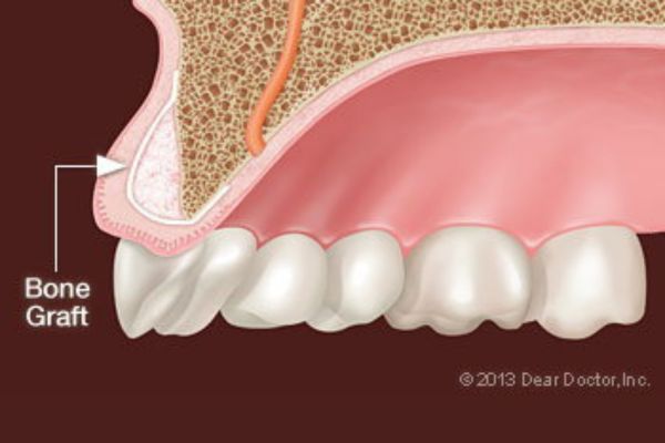 Bone Grafting
