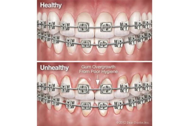 Orthodontics Oral Hygiene