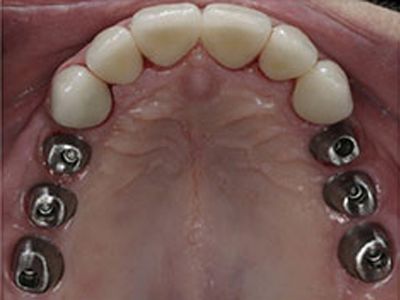 Dental Implant Process