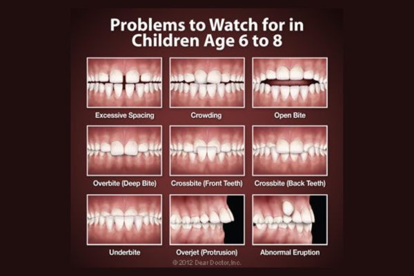 Early Orthodontic Treatment