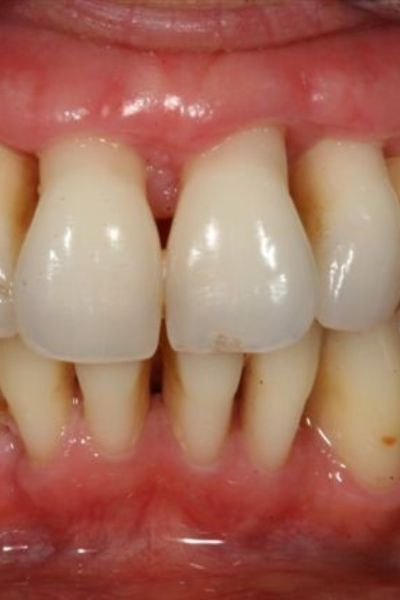 Deep Dental Pockets