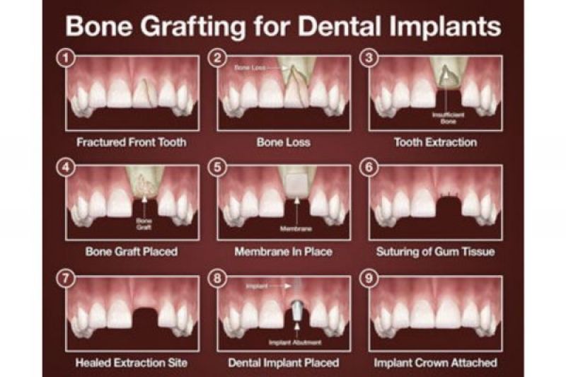 Bone Grafting