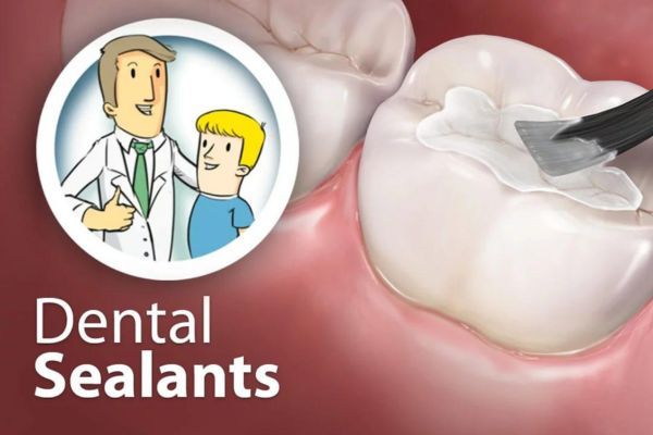 Dental Sealants
