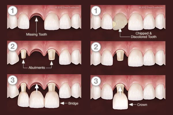 Crowns and Bridgework