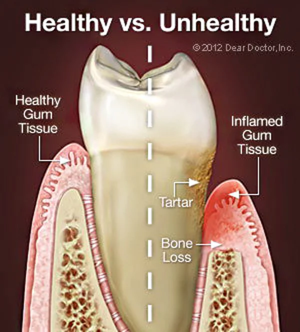 Healthy vs Unhealthy Teeth