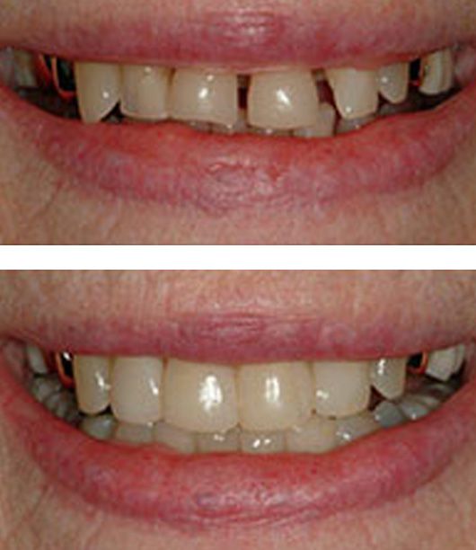 Benefits of Dental Fillings