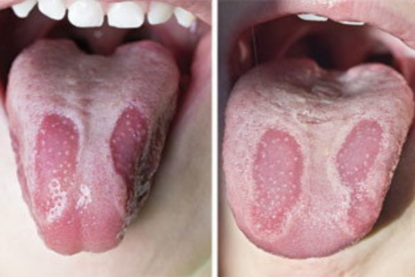 Geographic Tongue