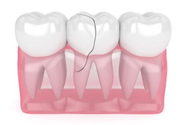 Broken Teeth