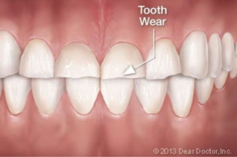 Stress and Oral Habits