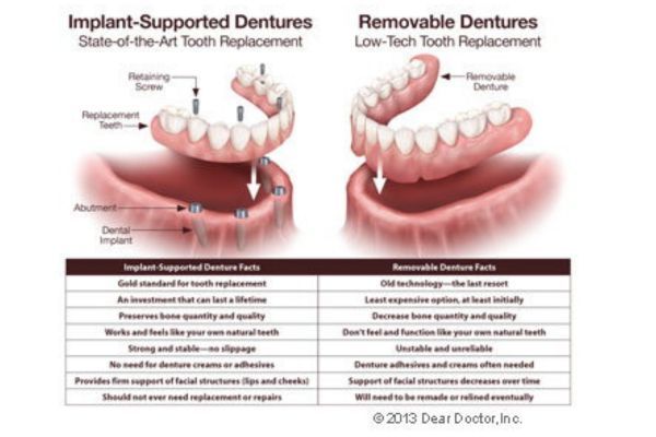 Implant Dentistry