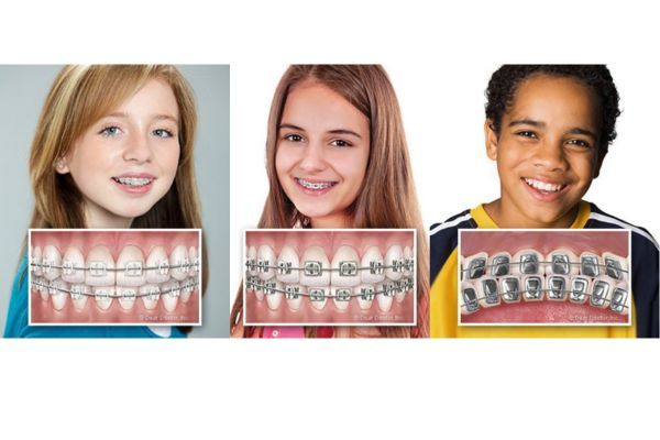 Types of Braces