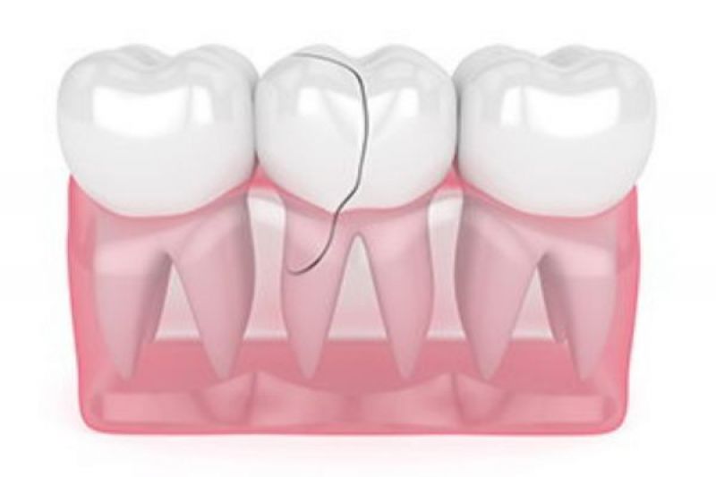 Broken Teeth