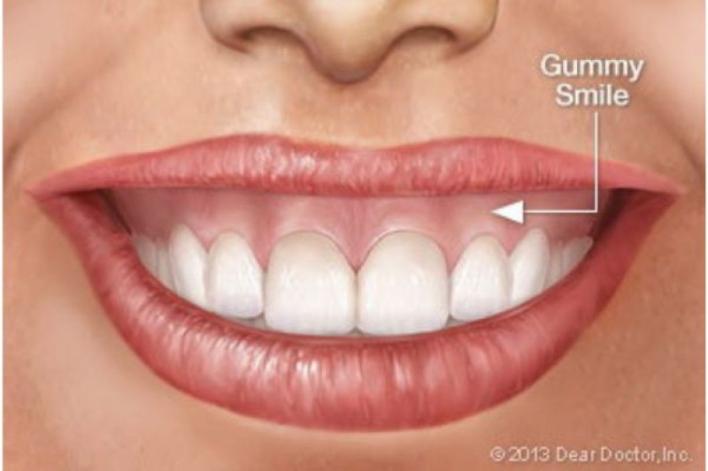 Gummy Smile