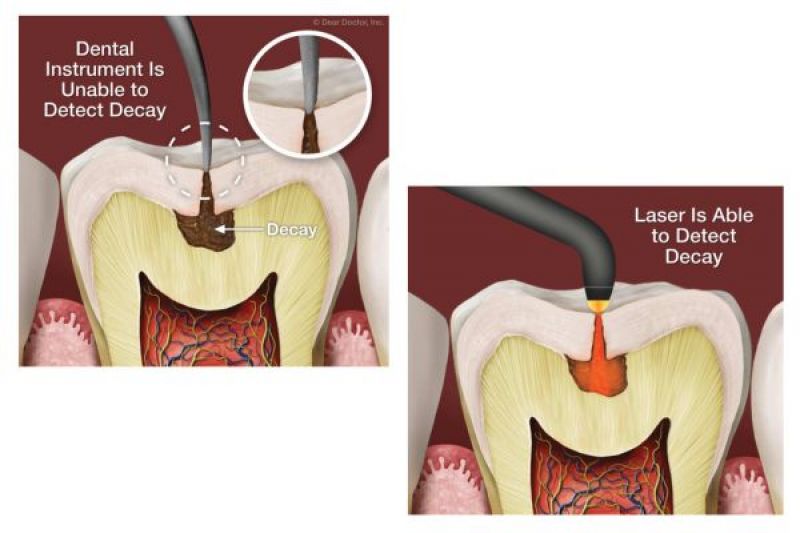 Laser Decay Diagnostics