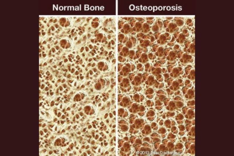 Osteoporosis Oral Bone Health
