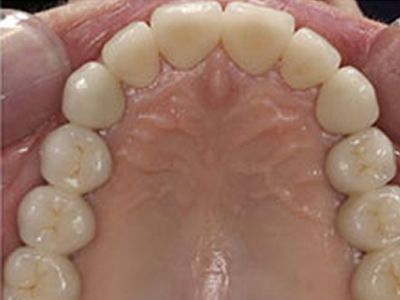 Dental Implant Process