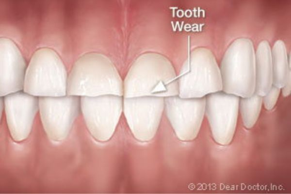 Stress and Oral Habits