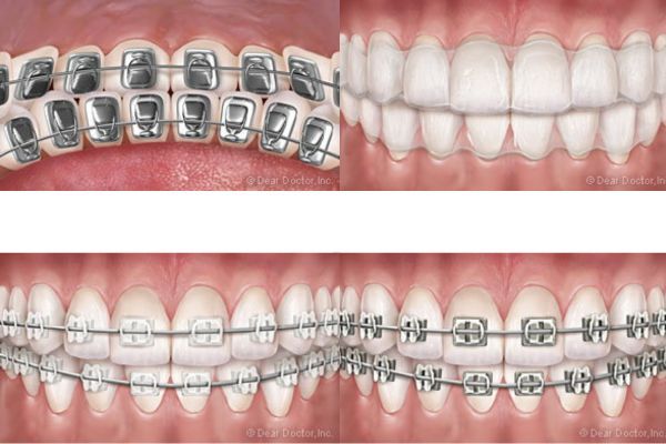 Adult Orthodontic Treatment