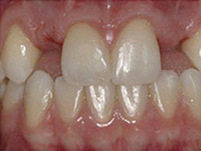 Dental Implant Process