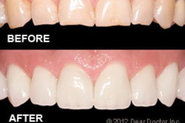 Porcelain Veneers