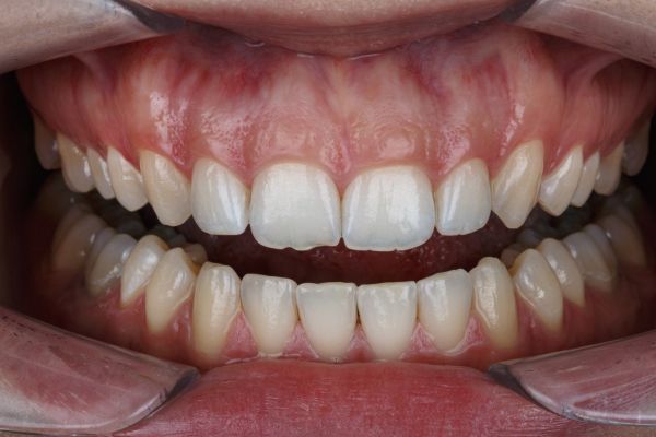 Corrective Jaw (Orthognathic) Surgery