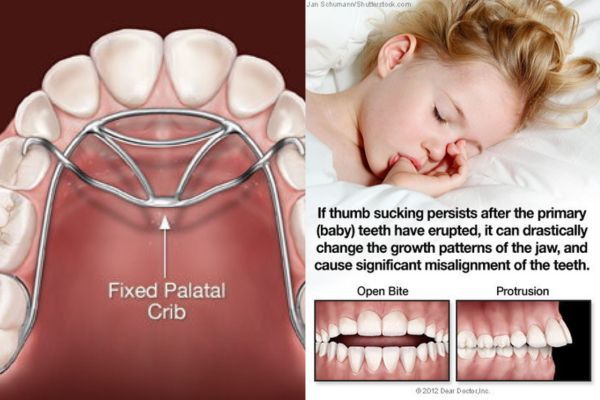 Thumb Finger Appliances