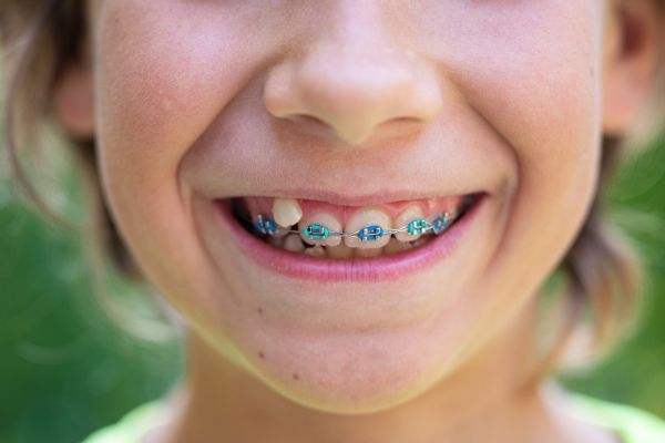 Adolescent Orthodontic Care