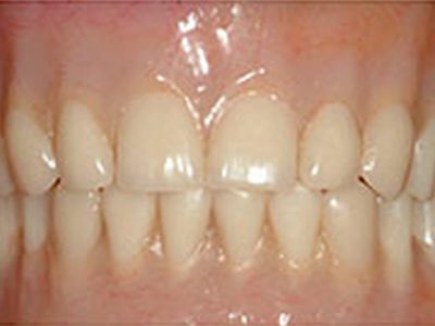 Dentures After