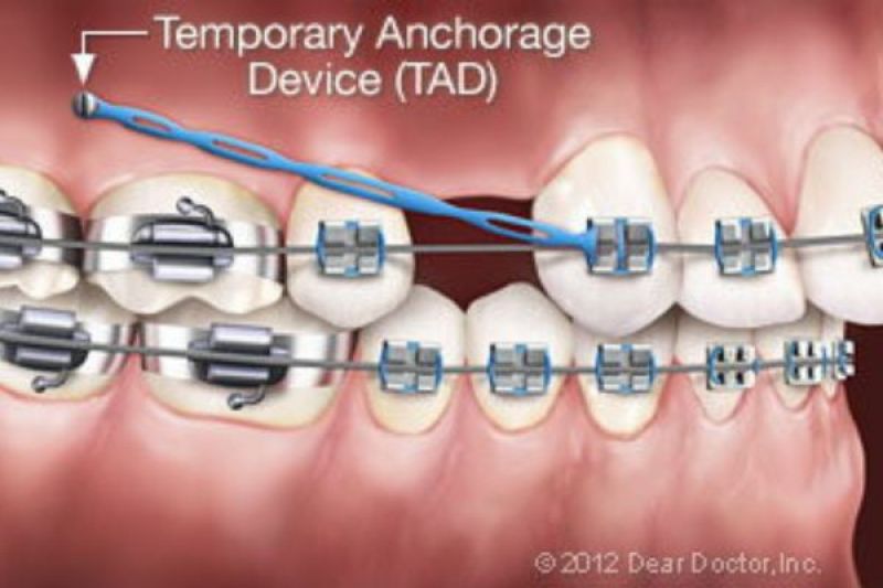 Temporary Anchorage Devide (TAD)