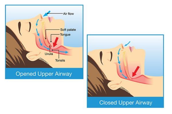 Sleep Apnea Airways