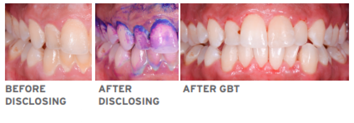 Guided Biofilm Therapy Before & After