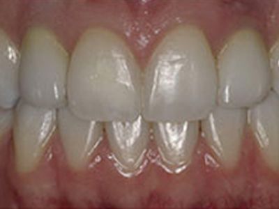 Dental Implant Process