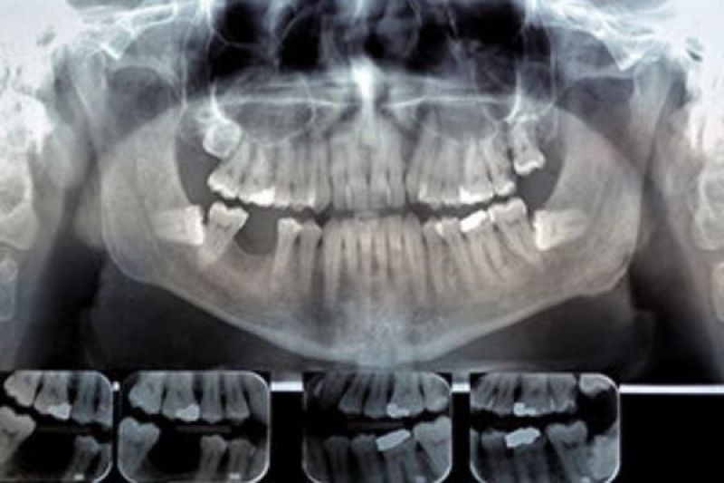 Digital X-Rays