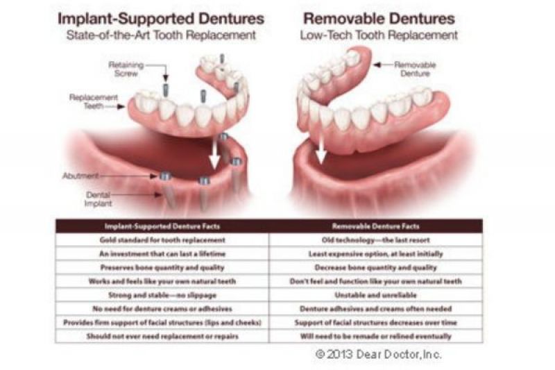 Implant Dentistry