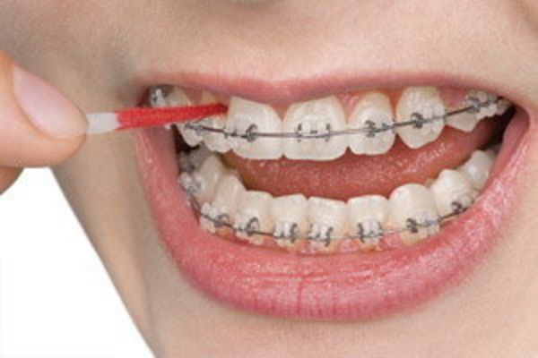 Brushing With Braces