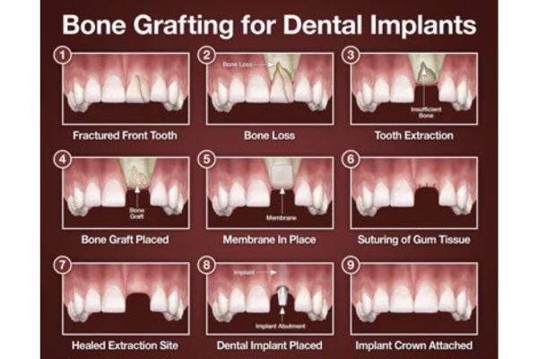 Bone Grafting