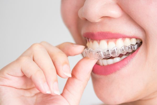 Adult Orthodontic Treatment