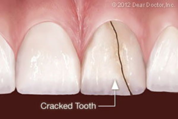 Cracked Tooth