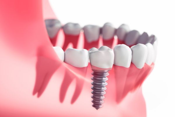 Top Reasons To Choose Dental Implants